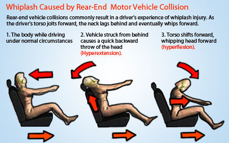 Whiplash injury caused by car accident