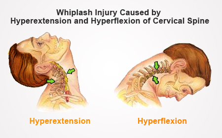 Comparison of Hyperextension with Hyperflexion - Whiplash