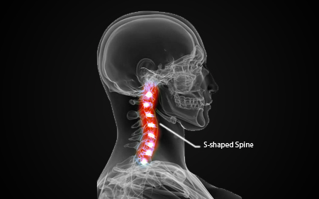 S-shaped spine due to whiplash