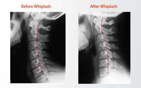 x-ray comparison: before and after whiplash
