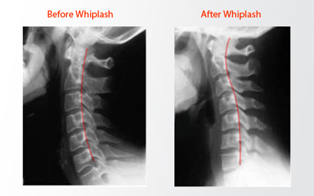 whiplash xray