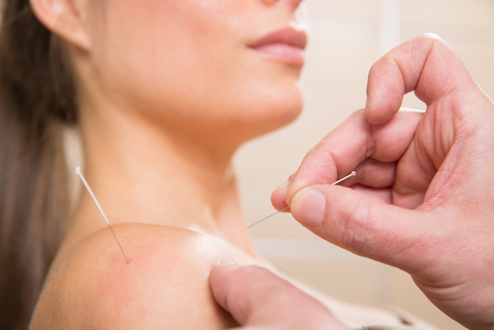 woman getting acupuncture in clinic