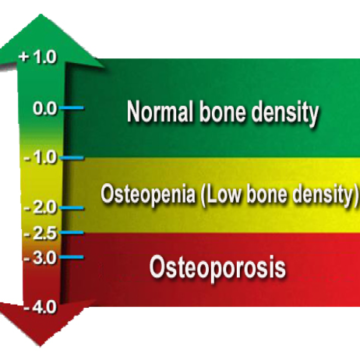 Chart showing normal bone density vs Osteoporosis