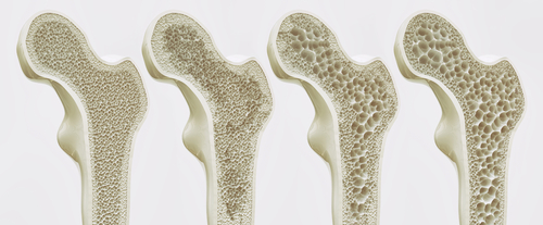 Photograph showing the progression of Osteoporosis in the Femur