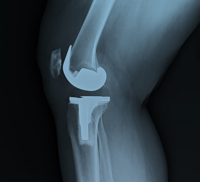 x-ray of patient's knee with a knee replacement